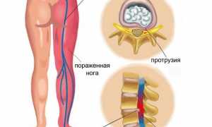 Ущемление нерва в тазобедренном суставе: лечение и симптомы