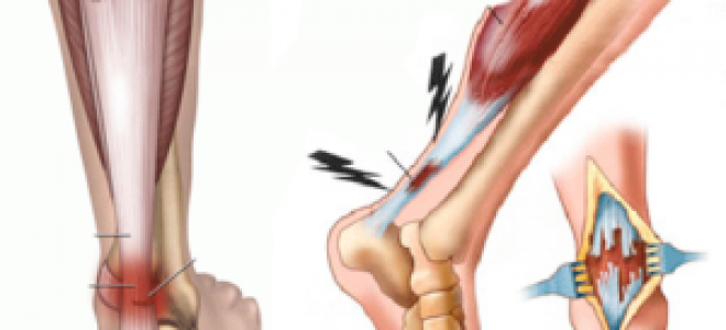 Повреждение связок голеностопного сустава. Почему оно происходит и как лечится